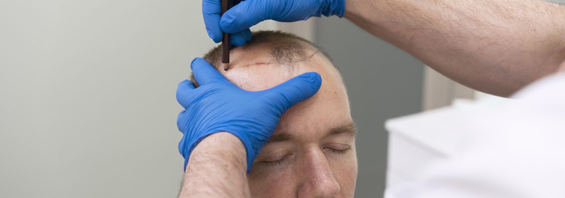 Everything you need to know about hair transplantation: Price, Process and Post-operative