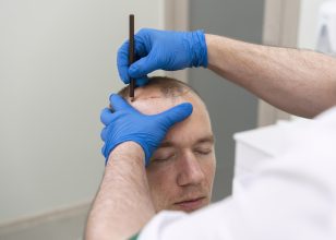 Everything you need to know about hair transplantation: Price, Process and Post-operative